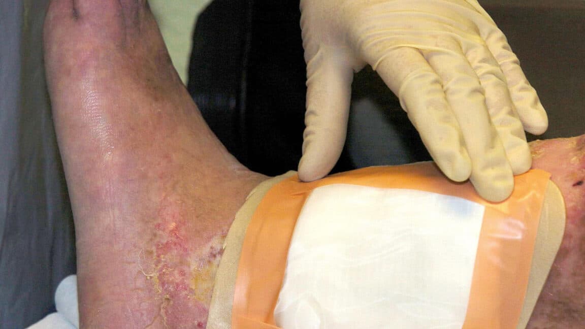 FDA Approves Second Maggot Therapy Species for Wound Care